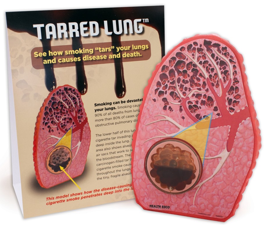 79234- NEED WEBSNIPPED Tarred Lung Model - Image 2