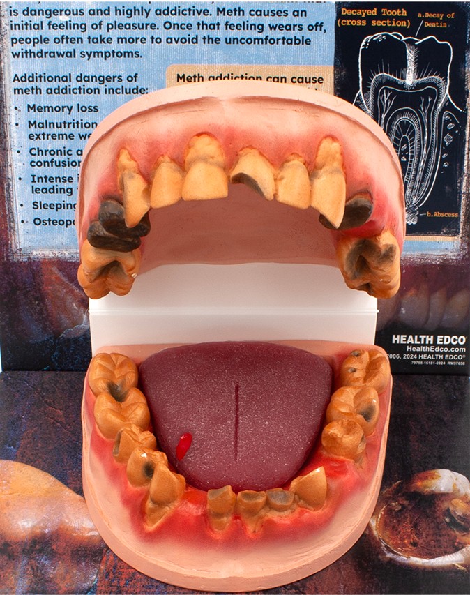 79758- NEED WEBSNIPPED 3 Meth Mouth: An Inside Look Display - Image 4