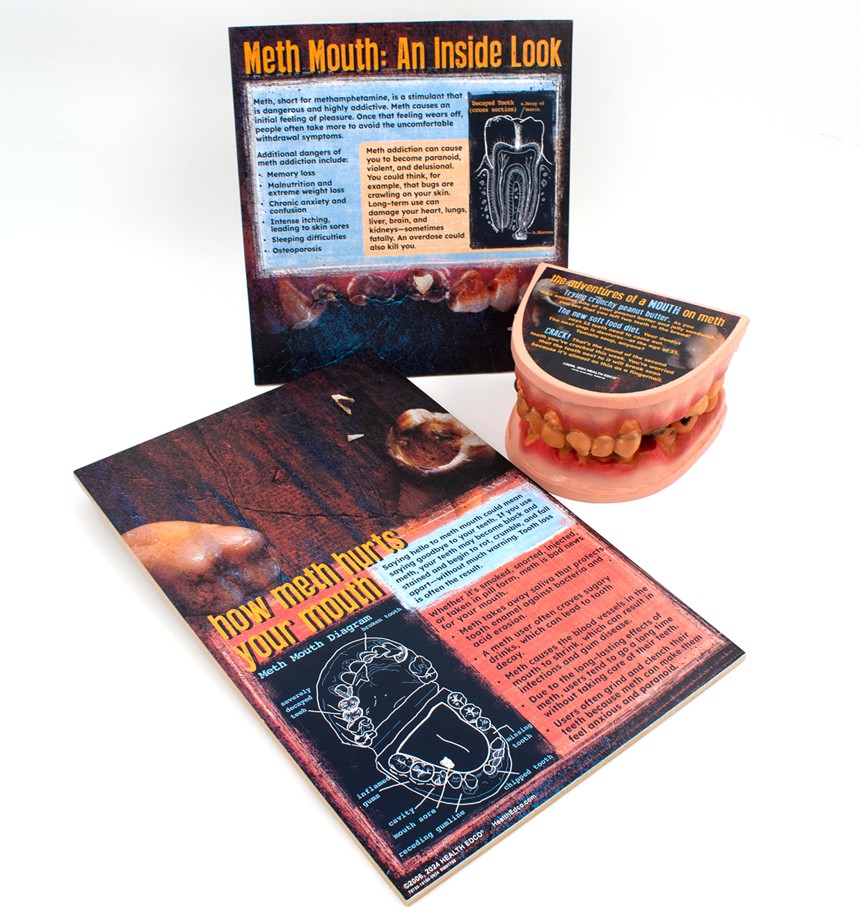79758- NEED WEBSNIPPED Meth Mouth: An Inside Look Display - Image 2
